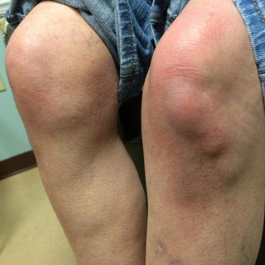 Swollen artrhritic knee